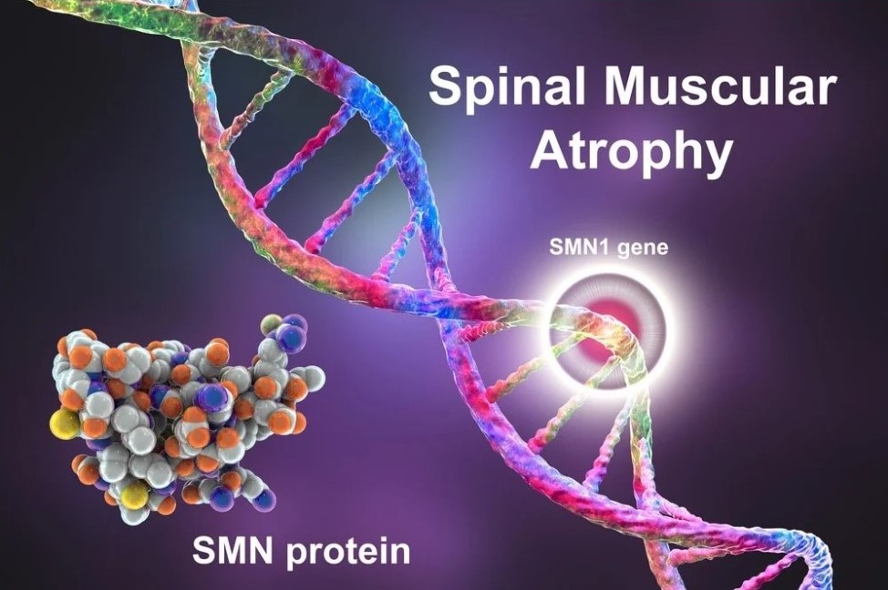 بیماری اس ام ای - SMA (Spinal Muscular Atrophy)