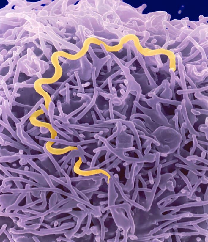 عفونت باکتریای سیفلیس، راه های تشخیص و درمان